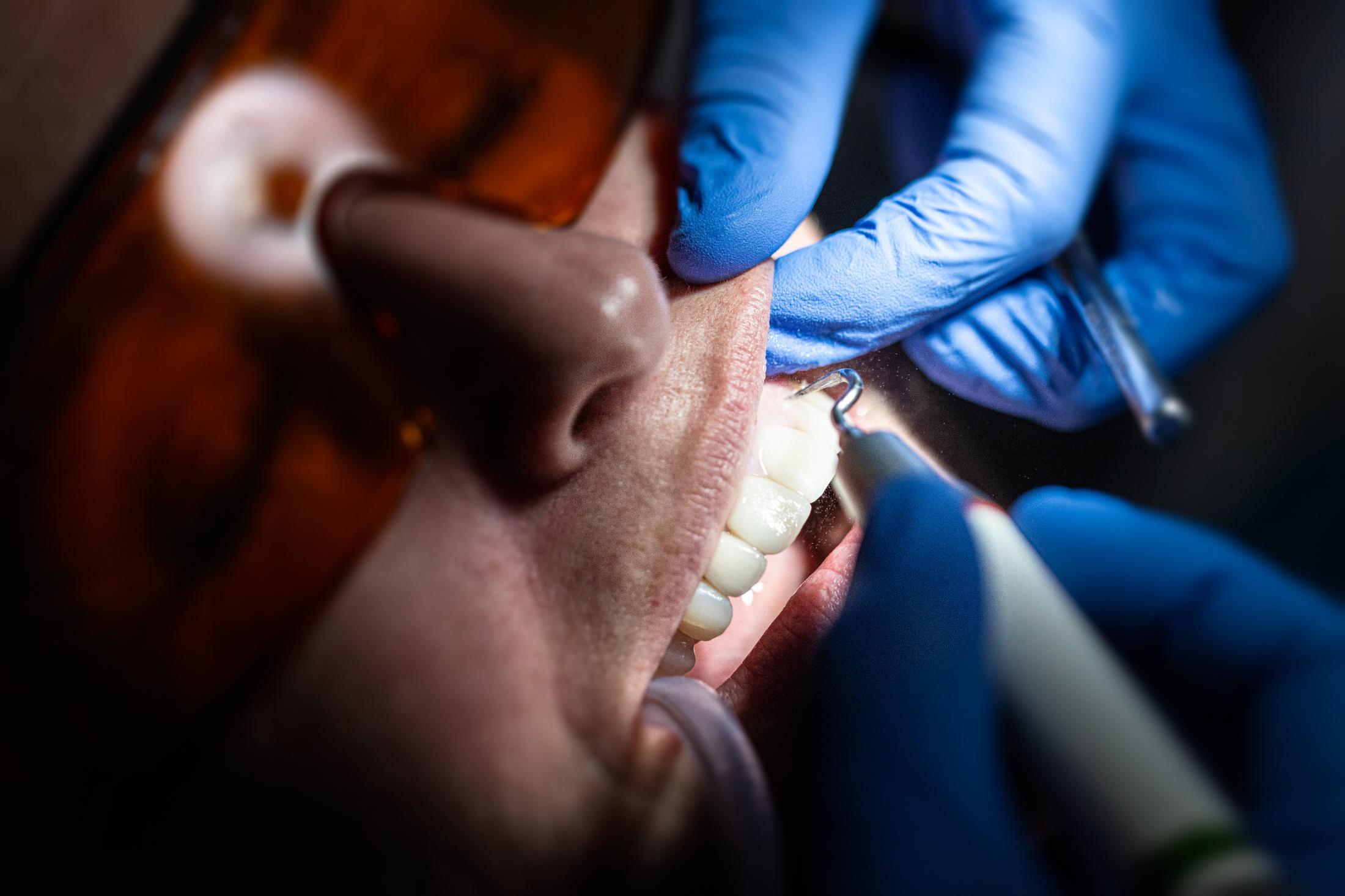 Primer pla d'un tractament dental