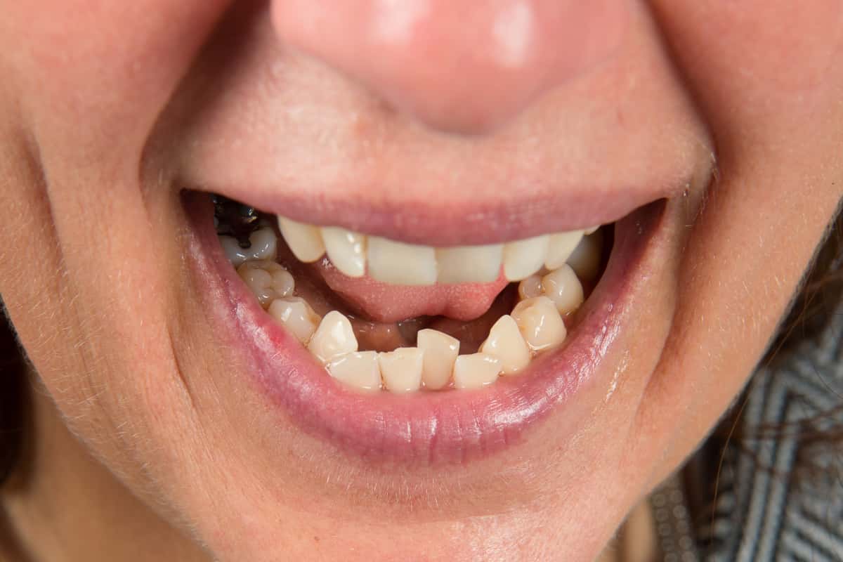 Dents en ventall